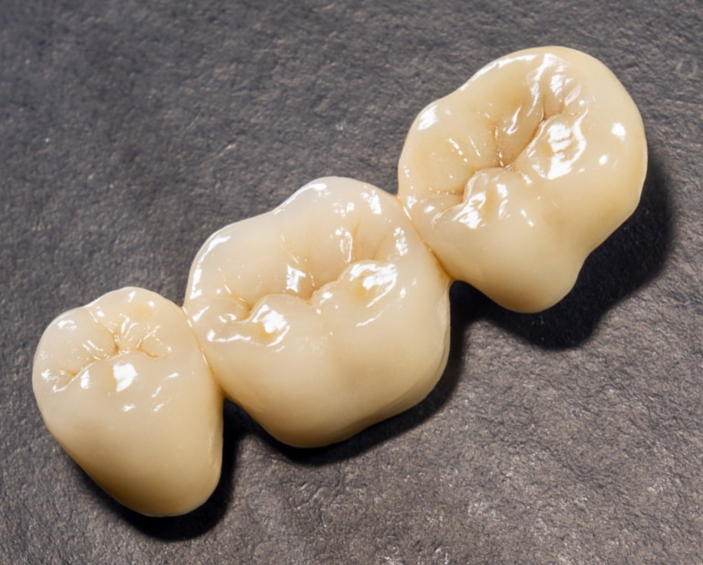 bigstock-Ceramic-Tooth-Crowns-And-Metal-327355561_edited_edited